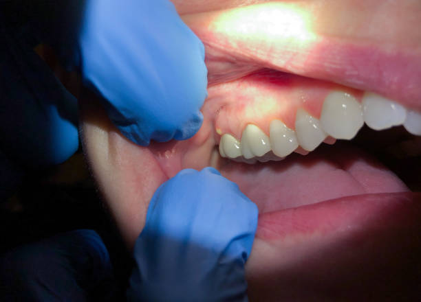 Best Emergency Dentist for Lost Fillings or Crowns in Navassa, NC